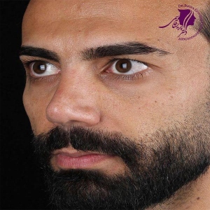 rhinoplasty-376