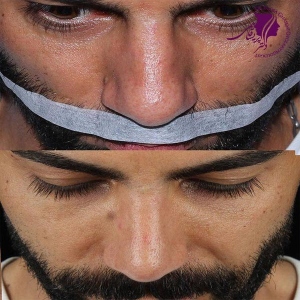 rhinoplasty-377
