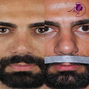 rhinoplasty-378