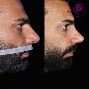 rhinoplasty-379