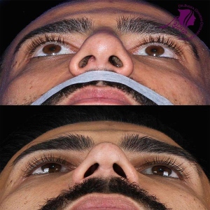 rhinoplasty-380