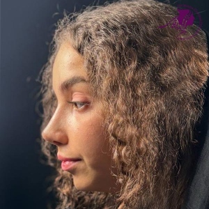rhinoplasty-381