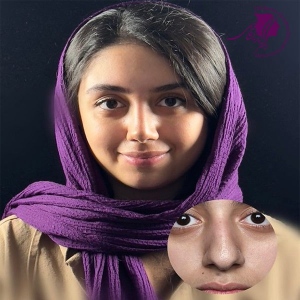 rhinoplasty-382