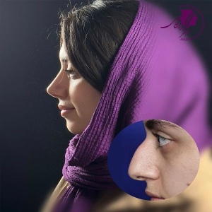 rhinoplasty-383