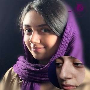 rhinoplasty-384
