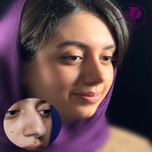 rhinoplasty-385
