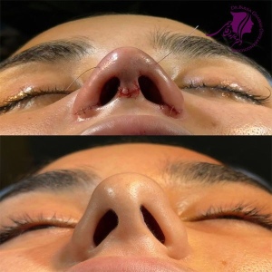rhinoplasty-386