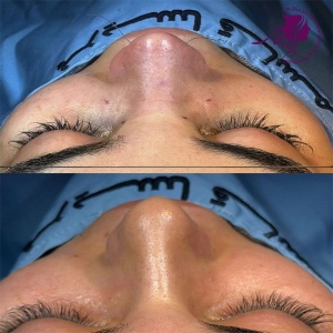 rhinoplasty-387