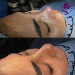 rhinoplasty-388