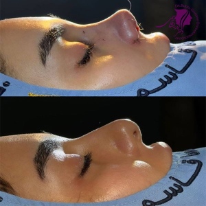 rhinoplasty-389