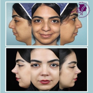 rhinoplasty-395