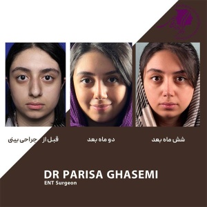 rhinoplasty-396