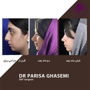 rhinoplasty-397