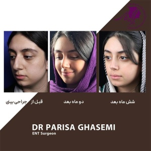rhinoplasty-398