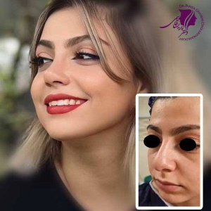 rhinoplasty-400
