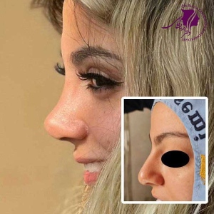 rhinoplasty-401