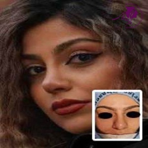 rhinoplasty-402