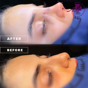 rhinoplasty-403