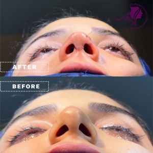 rhinoplasty-404