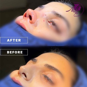 rhinoplasty-405
