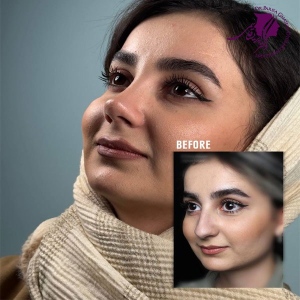 rhinoplasty-406