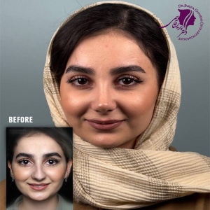 rhinoplasty-407