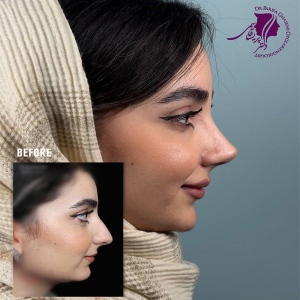 rhinoplasty-408