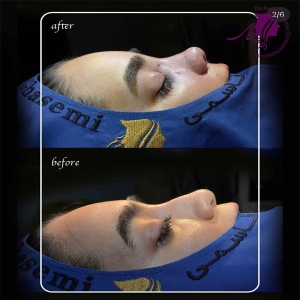 rhinoplasty-409