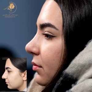rhinoplasty-411