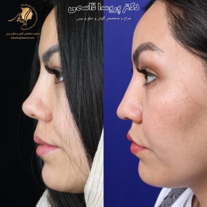 rhinoplasty-426