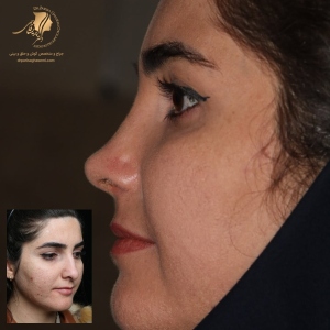 rhinoplasty-430