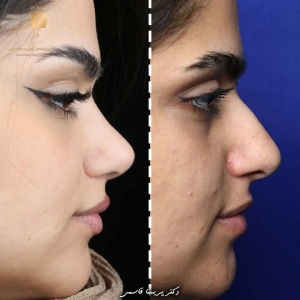 rhinoplasty-433