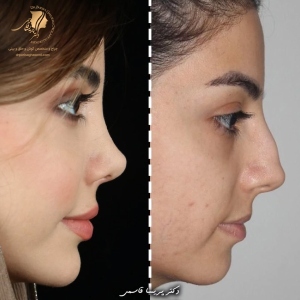 rhinoplasty-434