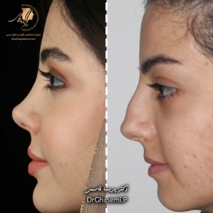 rhinoplasty-435