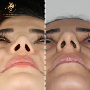 rhinoplasty-437