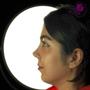 rhinoplasty390