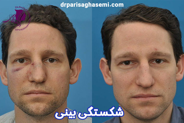 شکستگی بینی - دکتر پریسا قاسمی
