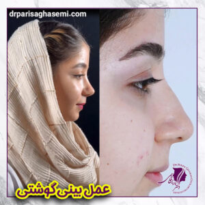 عمل بینی گوشتی - دکتر پریسا قاسمی