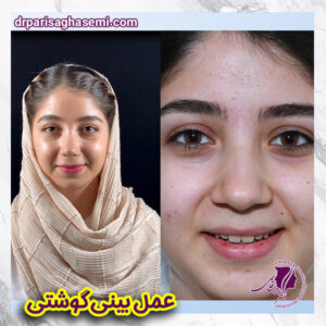 عمل بینی گوشتی - دکتر پریسا قاسمی