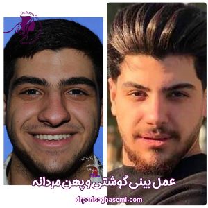 عمل بینی گوشتی مردانه - دکتر پریسا قاسمی 