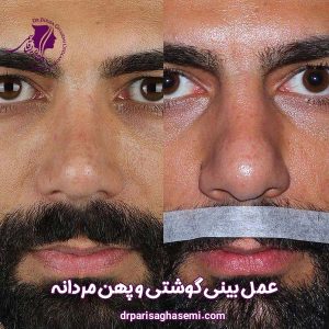 عمل بینی گوشتی مردانه - دکتر پریسا قاسمی 