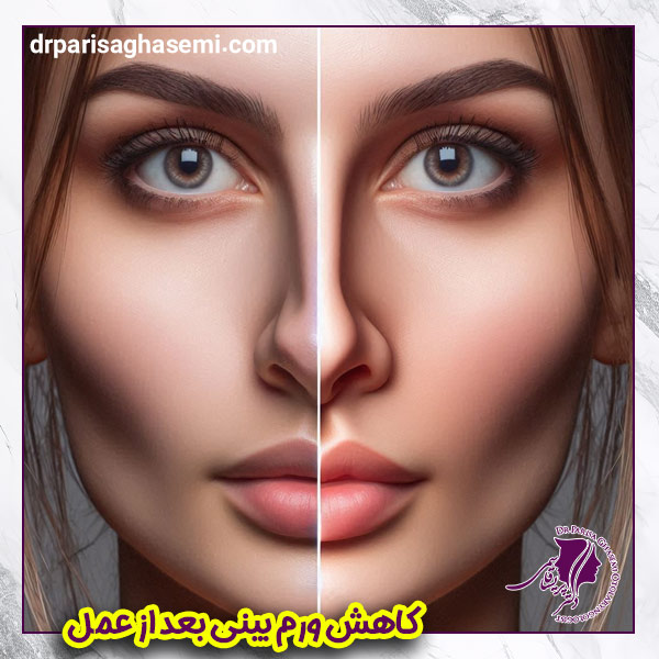 ورم بینی بعد از عمل - دکتر پریسا قاسمی