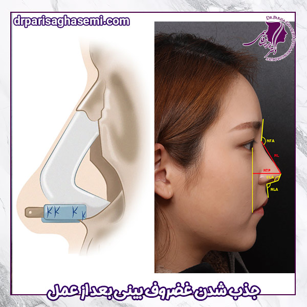 جذب شدن غضروف بینی بعد از عمل - دکتر پریسا قاسمی 