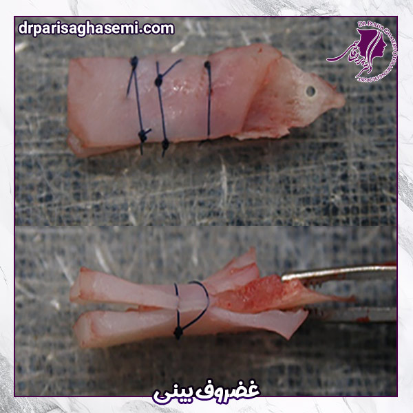  غضروف بینی - دکتر پریسا قاسمی 