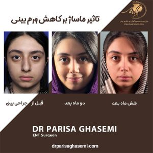 عکس ماساژ بینی بعد از عمل - دکتر پریسا قاسمی