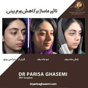 عکس ماساژ بینی بعد از عمل - دکتر پریسا قاسمی