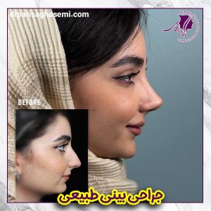 جراحی بینی گوشتی طبیعی - دکتر قاسمی 