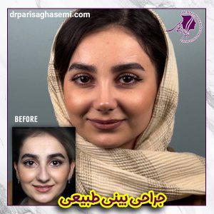 جراحی بینی گوشتی طبیعی - دکتر قاسمی 