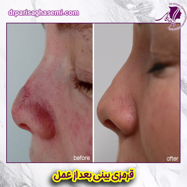 قرمزی پوست بینی بعد از عمل - دکتر پریسا قاسمی 