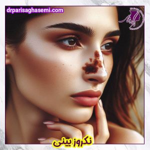 نکروز بینی - دکتر قاسمی